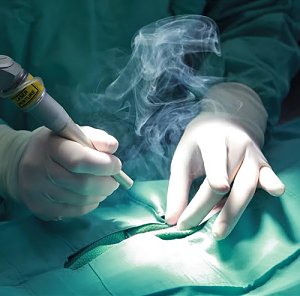 El humo quirúrgico es vapor de agua que puede contener sustancias tóxicas y enfermedades